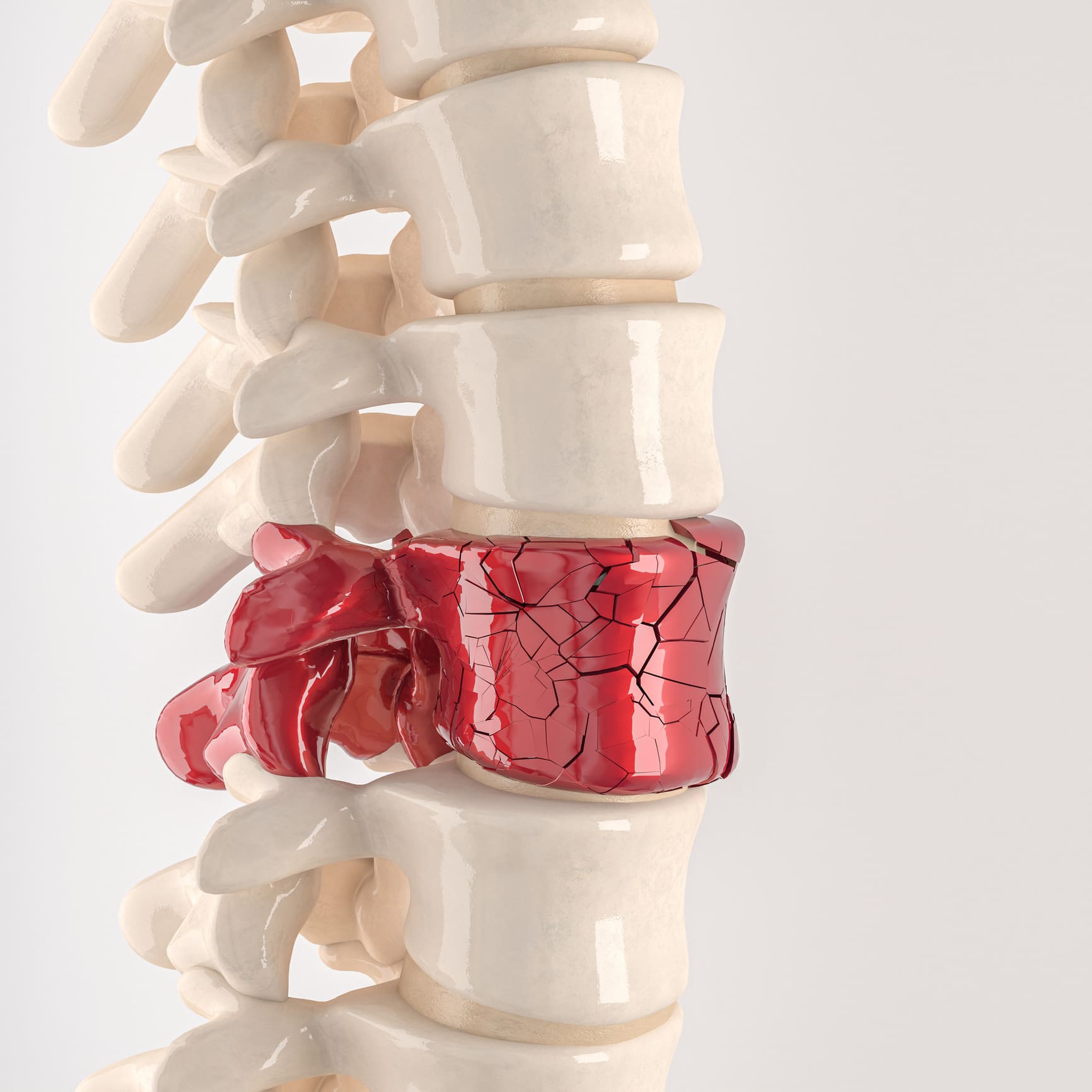 spine with shattered vertebrae. spine with shattered vertebrae. concept of physical discomfort. 3d render